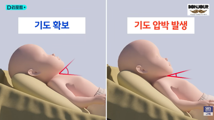 역류방지쿠션으로 인해 기도압박이 될 수 있다는 뉴스보드 화면 캡처