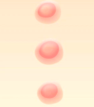 빈대-물린-자국