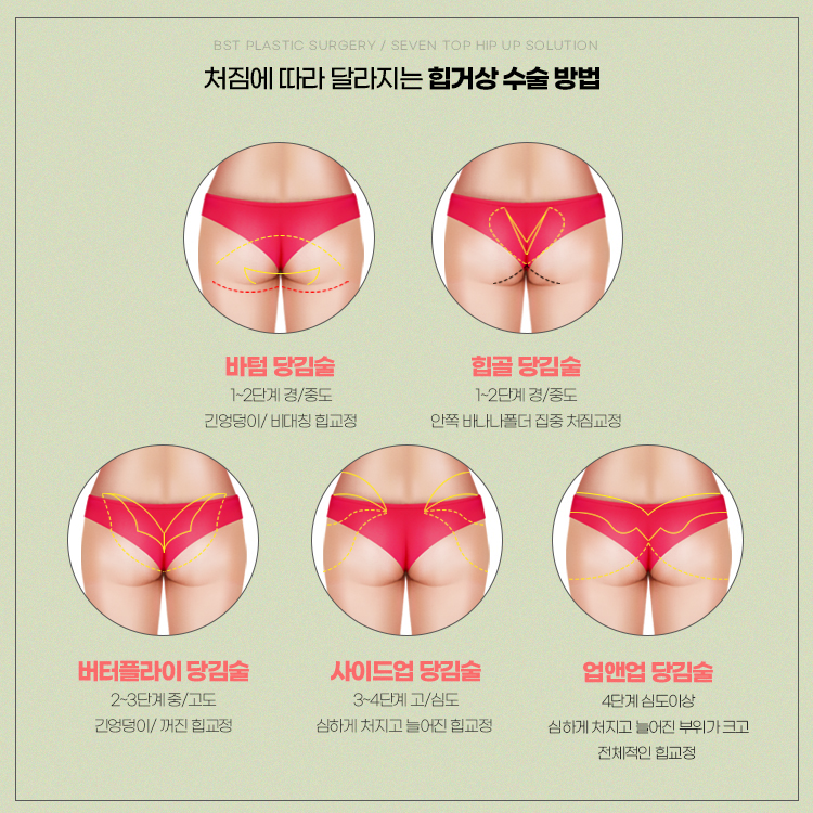 엉덩이 처짐에 따라서 힙거상수술의 절개 방법도 달라집니다.