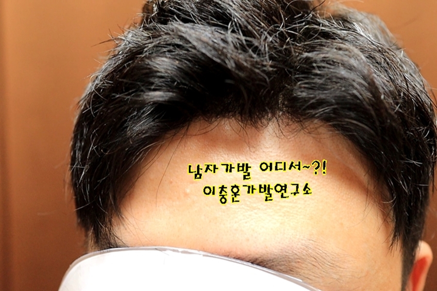 남자부분가발 선택법