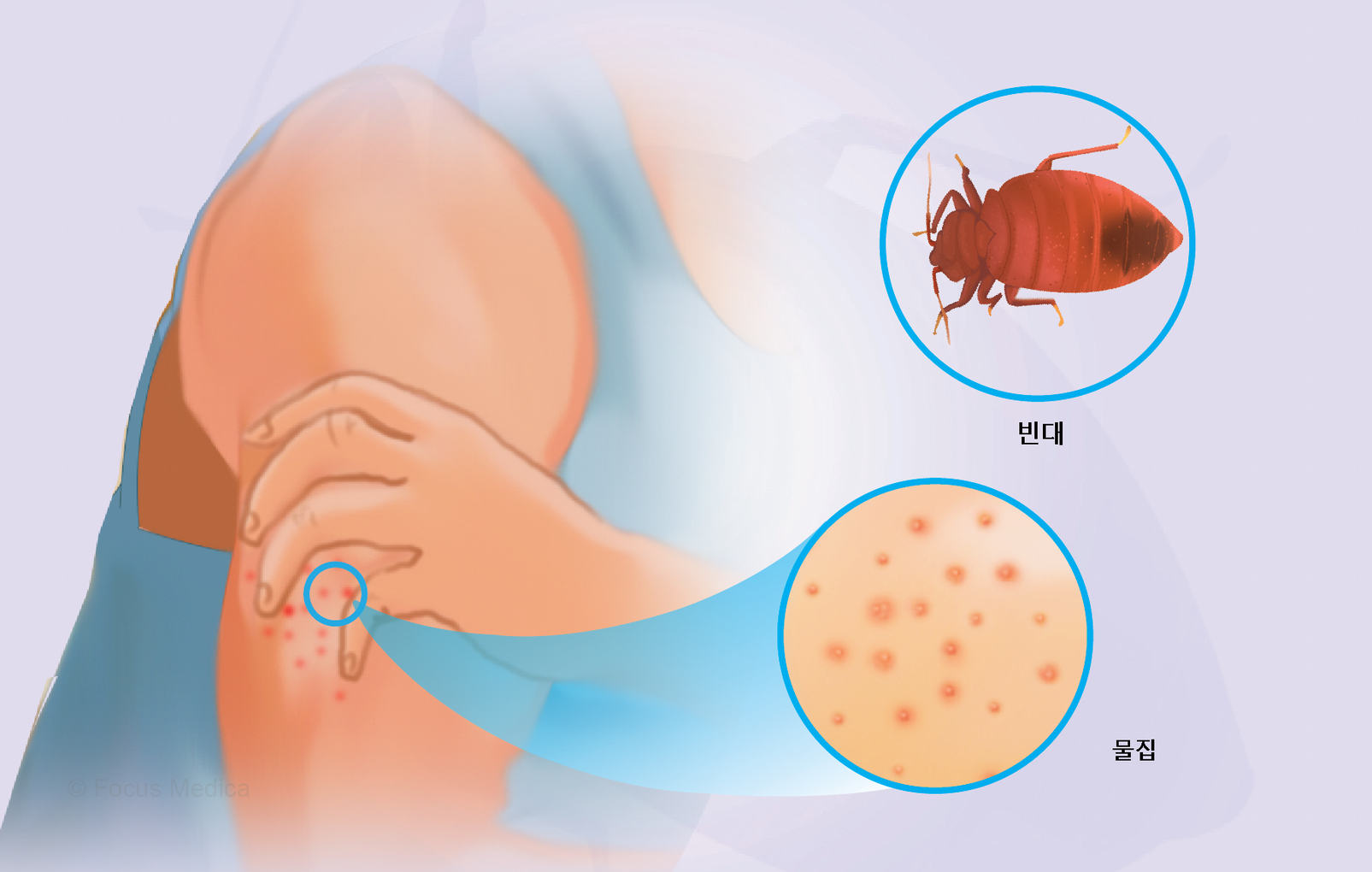 빈대물렸을때증상1