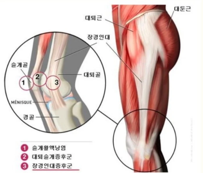 무릎-통증-부위도