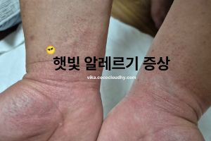 햇빛 알레르기 증상