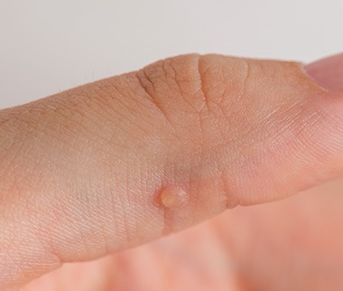 손가락 사마귀가 발현된 사진