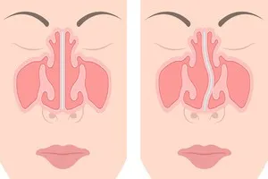축농증-수술비용