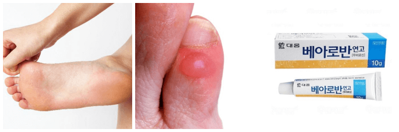 발, 발가락 물집, 베아로반 연고 사진