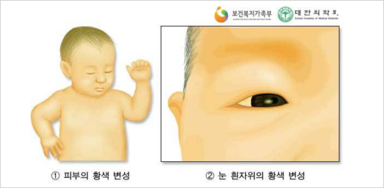 신생아 황달