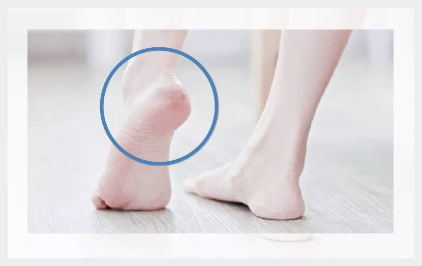 발뒤꿈치 통증