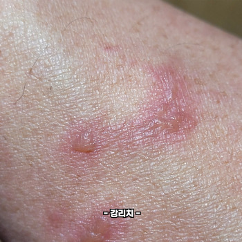 대상포진 치료방법