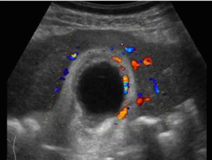 급성 담낭염 (Acute cholecystitis)