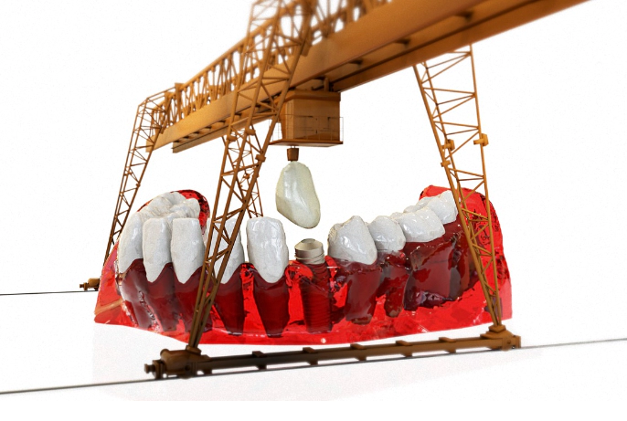 임플란트-건강-보험-종류