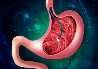 대장내시경 전 음식 주의사항과 대장내시경 약 복용법