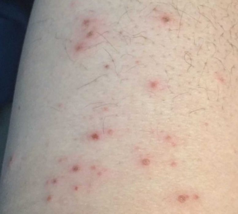 좀벌레 물린자국