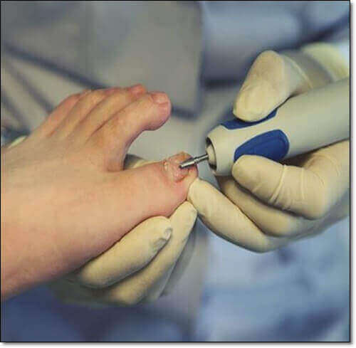 발톱 조갑박리증 치료