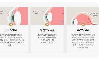 . 포도막염의 원인