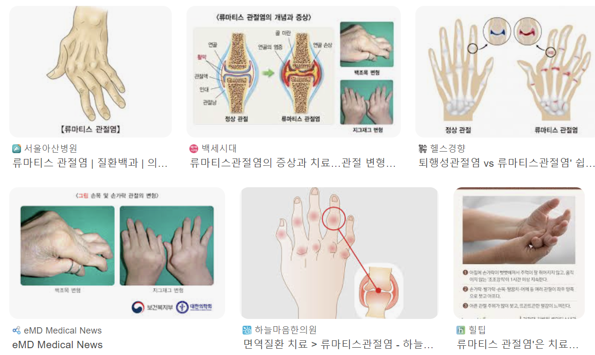 류마티스 관절염 초기증상 2