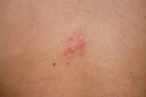 대상포진 증상