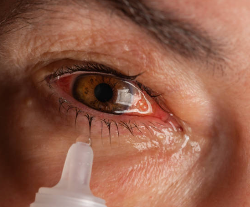 안구 건조증 증상