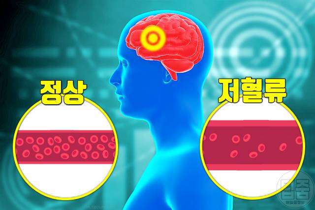 뇌경색 여름철 질병 여름질병 열사병