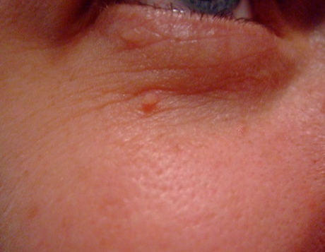 비립종 생기는 이유