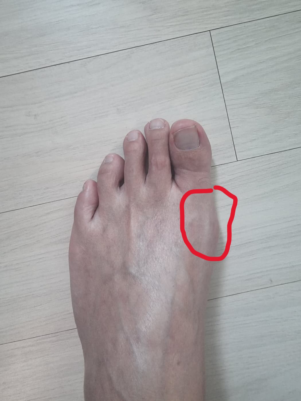 엄지발가락 통증의 원인 그리고 무지외반증이란?