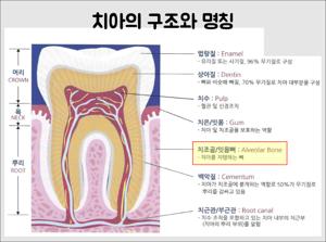 무절개 임플란트