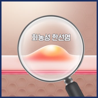 화농성 한선염 치료 수술 병원