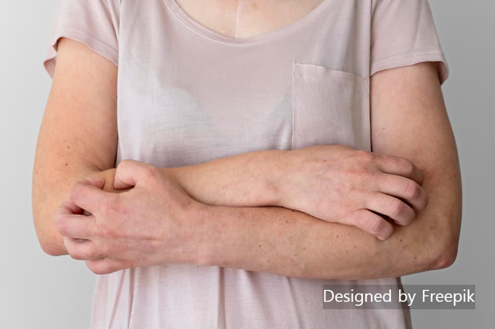 콜린성 두드러기 증상