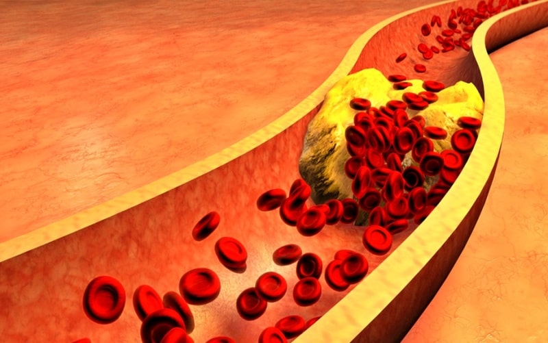 중성지방 정상수치
