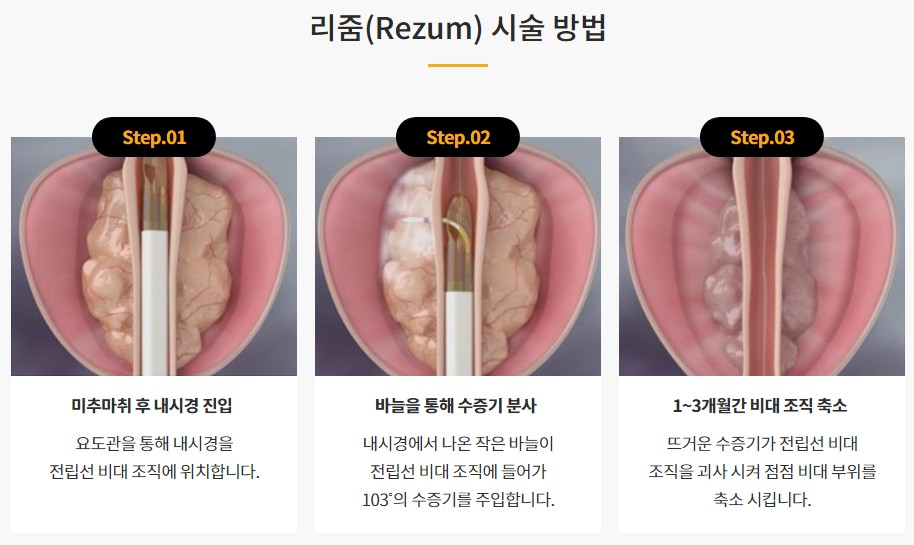 alt="리줌수술과정"