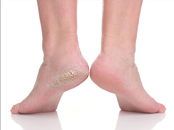 갈라진뒤꿈치관련이미지