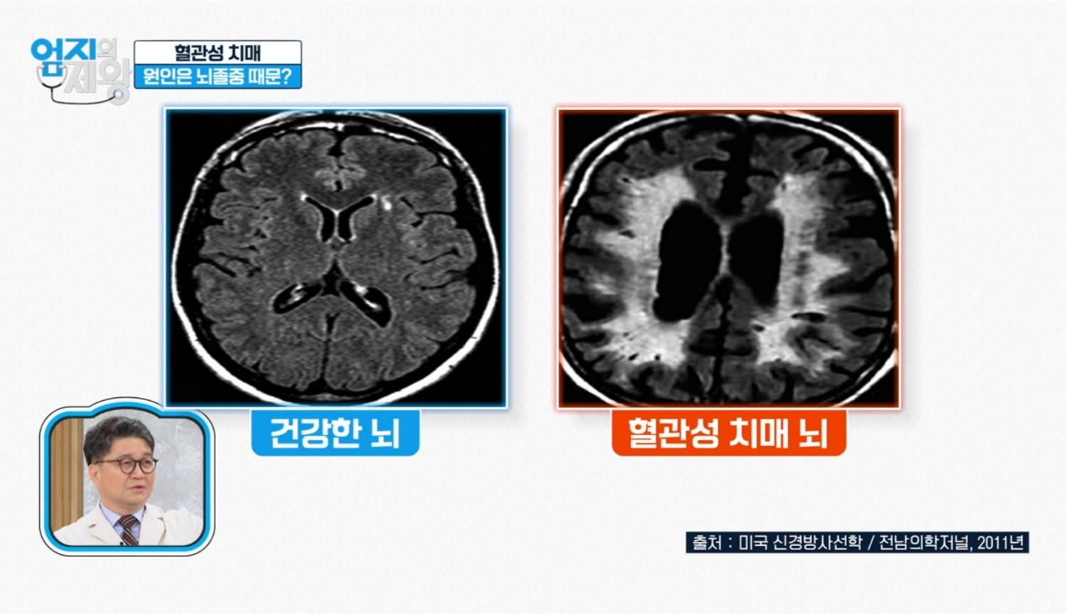 혈관성 치매 예방