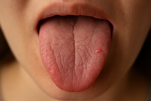갈라짐과 염증이 나타난 혓바닥(출처: 자체제작)