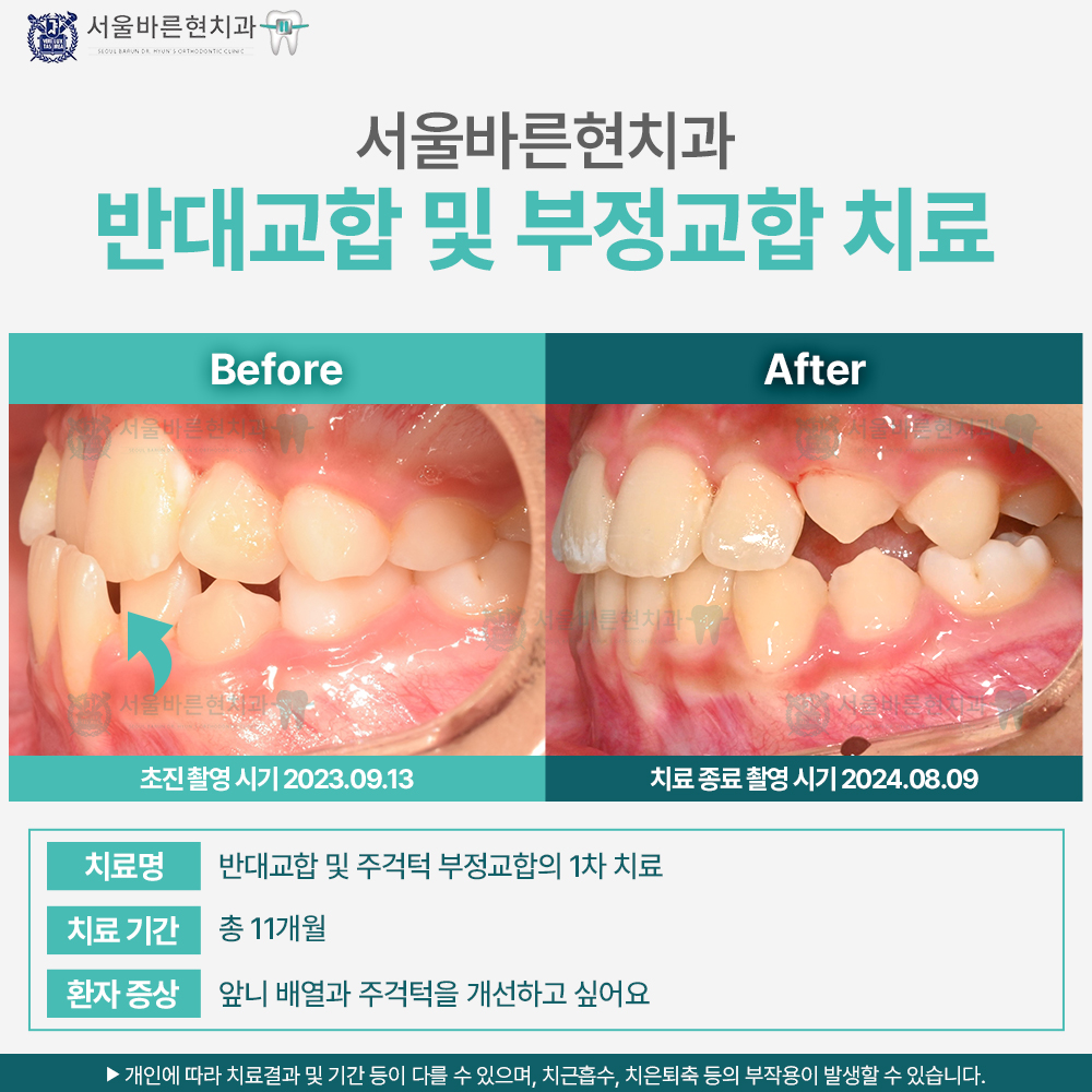 부산치아교정