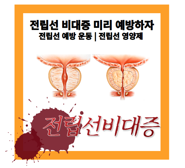 전립선 비대증을 막자
