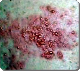 대상포진 초기증상 19