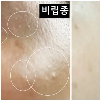 비립종 생기는 이유 비립종 없애는 방법 피부 관리법_24