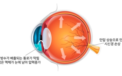 녹내장 이미지