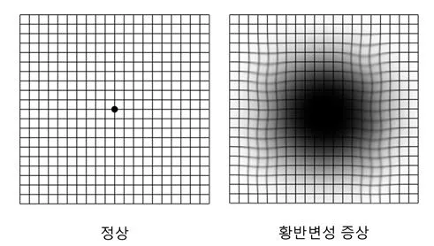 시야에 검은점 시야에 까만점이 보일때 원인과 대처법_4