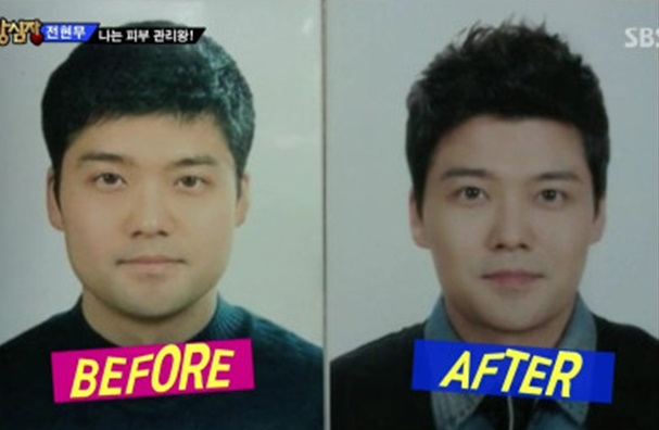 전현무 보톡스 시술 전 후