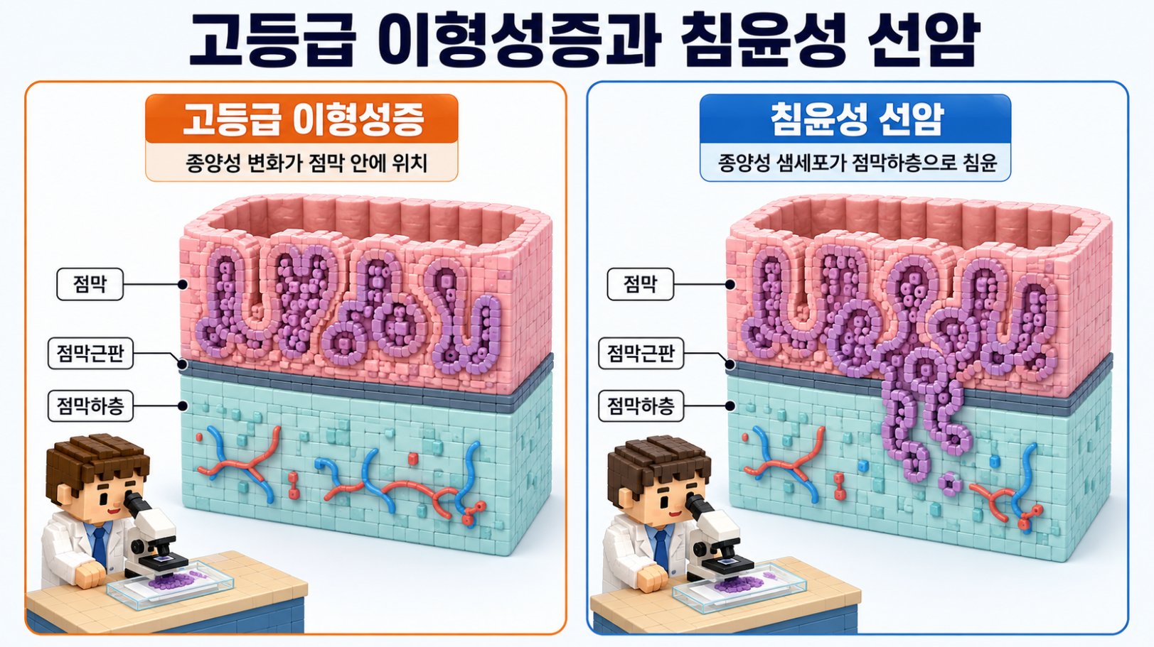 고등급 이형성증과 점막근판을 넘어 점막하층으로 침윤한 선암의 해부학적 차이