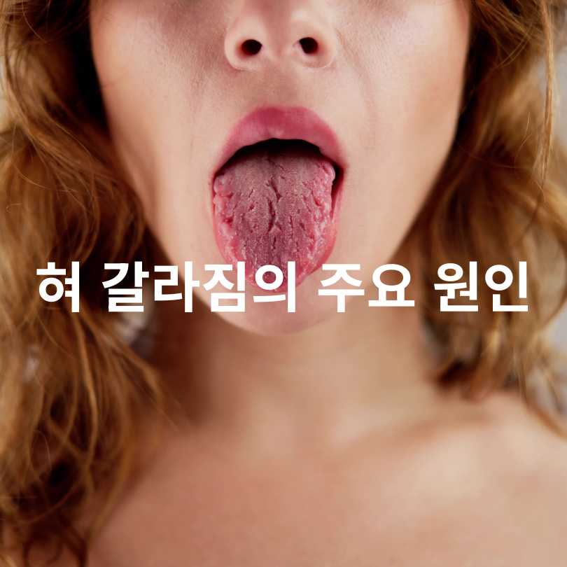 혀 갈라짐의 원인과 대처법