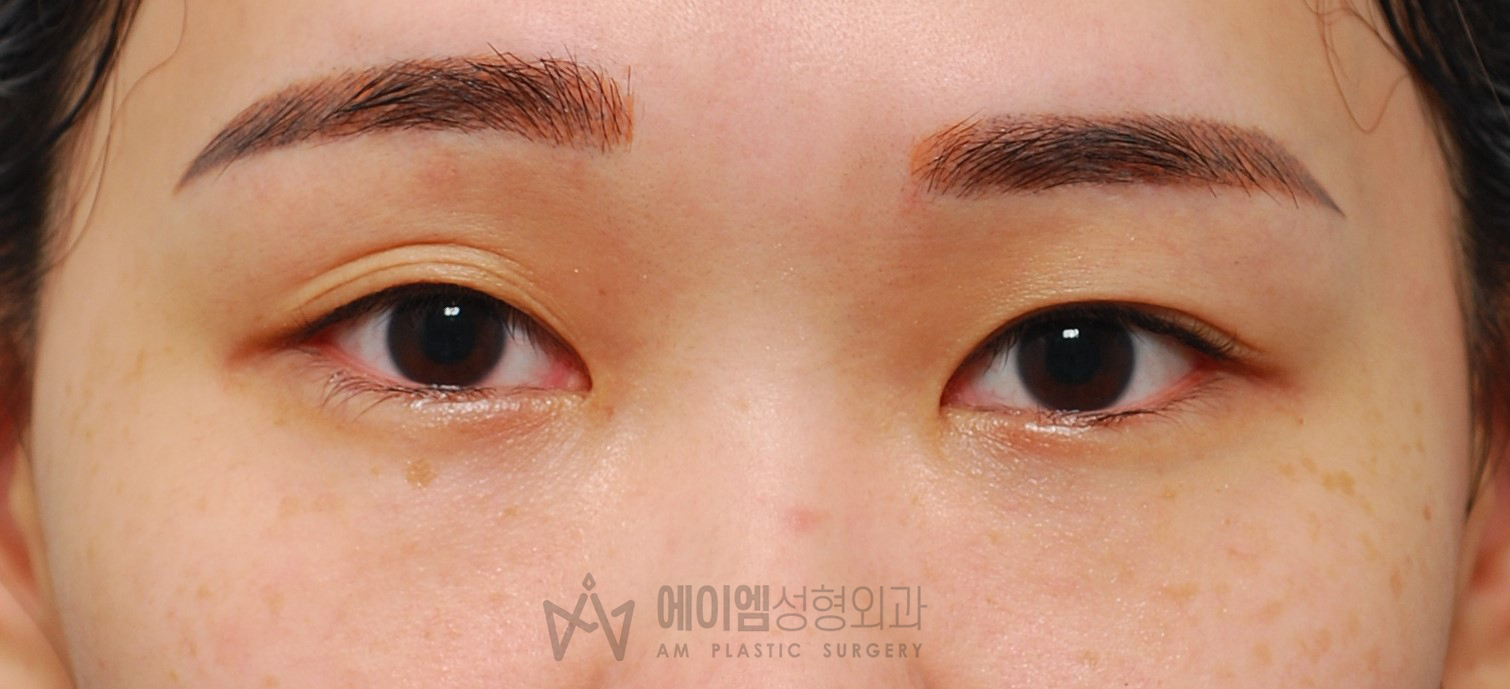 쌍꺼풀 풀림 수술 전