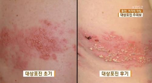 대상포진예방접종