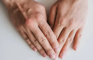 두드러기 원인 16