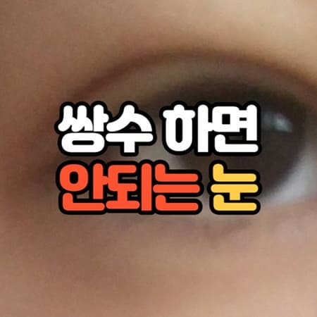 쌍수하면 안되는 눈