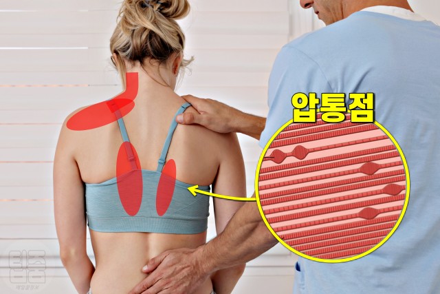 등 위쪽 통증 5, 등이 아픈 증세, 근막통증 증후군 증상, 생로병사의 비밀