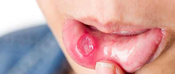 아래입술-염증-물집