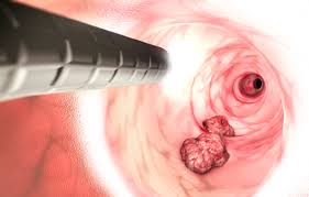 대장내시경 비용 총정리