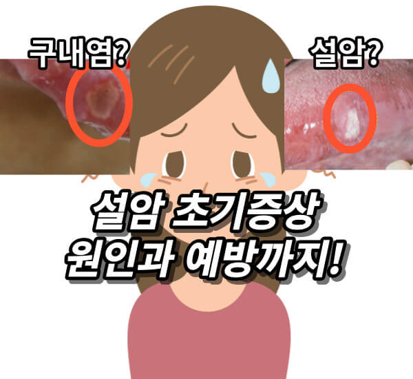 설암 초기증상, 원인과 예방법